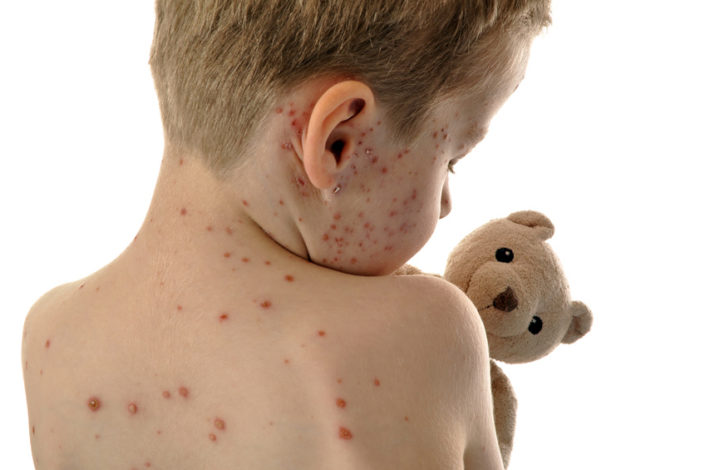 Épidémie varicelle France